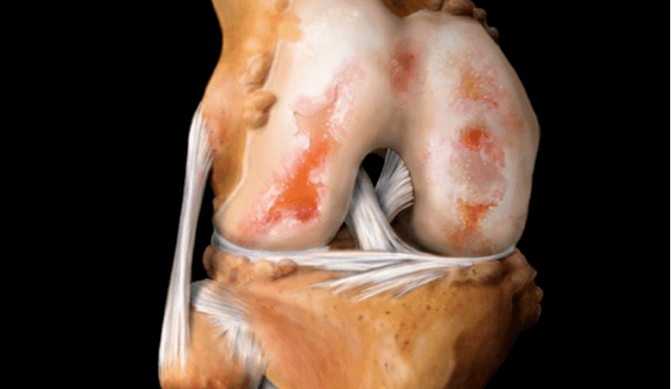 artrose da articulación do xeonllo
