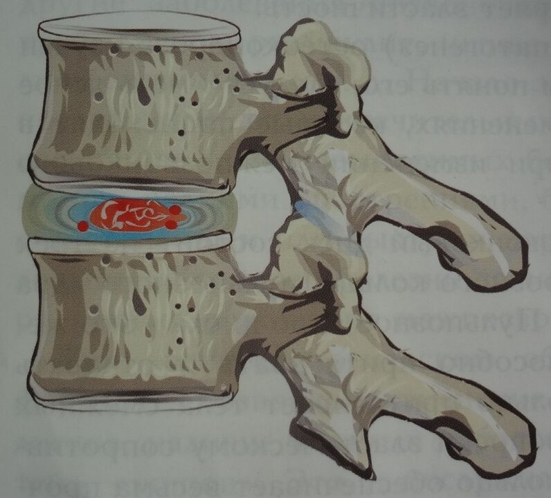 Dano ao núcleo pulposo do disco intervertebral na primeira fase da osteocondrose cervical