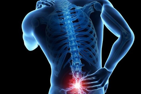 A dor lumbar aguda é un síntoma do desprazamento dos discos intervertebrais