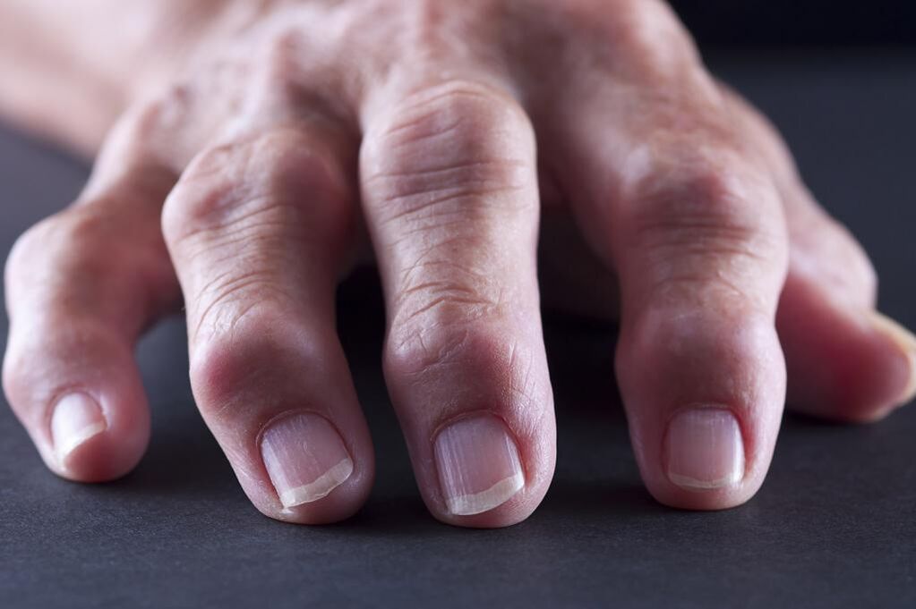 A bursite caracterízase por dor, inflamación e inchazo das articulacións dos dedos