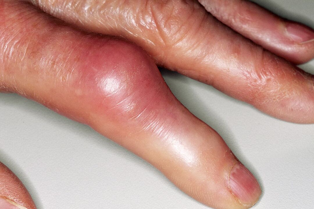 Inchazo, deformación da articulación do dedo e dor aguda despois da lesión
