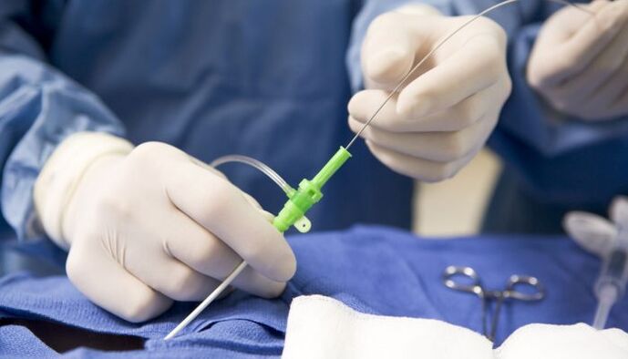 A ablación por radiofrecuencia é un dos métodos para tratar a osteocondrose cervical