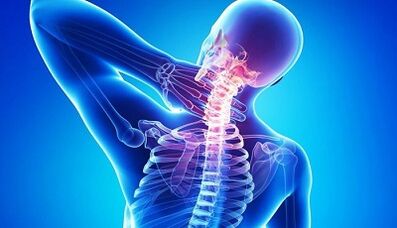 Síntomas e tratamento da osteocondrose cervical