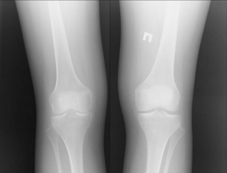 Radiografía de xeonllos afectados pola artrose