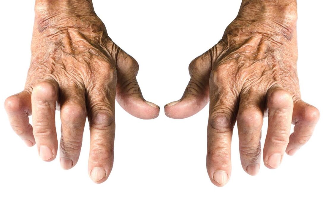 signos de artrite - deformidade articular